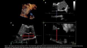 The use of cvp analysis requires several assumptions. Three Dimensional Inferior Vena Cava For Assessing Central Venous Pressure In Patients With Cardiogenic Shock Sciencedirect