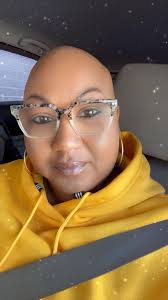 Do you have alopecia anxiety ??? Solution link in the comment section