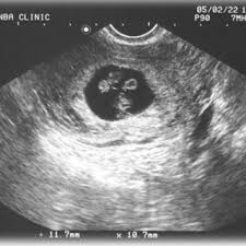 At this stage in a fetus' life its impossible to determine whether the twins are fraternal or identical. Transvaginal Ultrasound At 7 3 7 Weeks Of Gestation Two Fetuses With Download Scientific Diagram