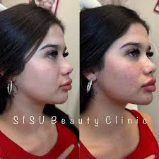 Half syringe of filler can add volume...