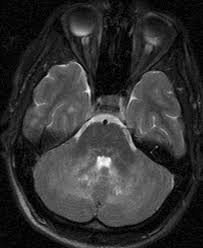 †department of radiology stony brook university in addition, we also present a unique case of newly described autoimmune entity clippers syndrome. Case 212 Chronic Lymphocytic Inflammation With Pontine Perivascular Enhancement Responsive To Steroids Radiology