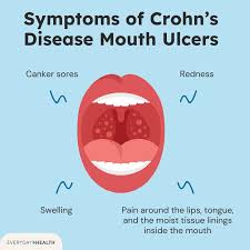 Image result for Canker sores symptoms roof of the mouth