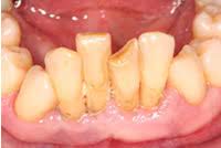If a tooth is extremely loose, a splint can be used to hold it in place. Stabilization Of Loose Teeth Cherry Hill Nj How To Treat Loose Teeth
