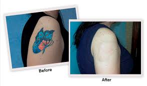 At the most, there may be some pinpoint bleeding, but never an open, bleeding wound. Tattoo Pigment Affordable Tattoo Removal Cheap Tattoo Removal Los Angeles