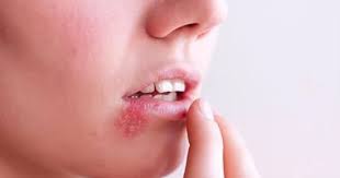 Here are 15 symptoms of mono. Ø§Ø·Ù…Ù† Ø¹Ù„Ù‰ Ù†ÙØ³Ùƒ Ù…Ø§ Ù‡Ùˆ ØªØ­Ù„ÙŠÙ„ ÙÙŠØ±ÙˆØ³ Ø¥Ø¨Ø´ØªØ§ÙŠÙ† Ø¨Ø§Ø± Ebv Ø§Ù„ÙŠÙˆÙ… Ø§Ù„Ø³Ø§Ø¨Ø¹