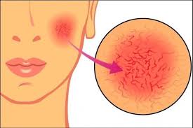 Por Que Salen Y Como Borrar Las Venitas Rojas Que Aparecen En El Rostro Bioguia