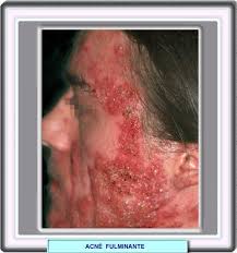 tratamientos para el acné mas actuales en mujeres: mayo 2010