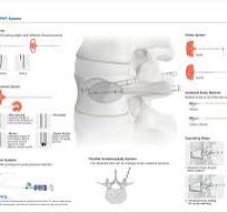 PKP Percutaneous Kyphoplasty System,Medical Device ...