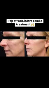 ✨Monday Makeover✨ Once again brought to you by ONE BBL Fotofacial and Ultra  laser combination treatment. , ✨✨Just one session made a big difference in  the tone and texture of the skin. If you aren’t ...
