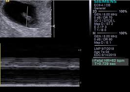 The fetal pole grows at a rate of about 1 mm a day, starting at the 6th week of gestational age. Understanding How 4 Abnormal Ultrasound Findings Relate To Miscarriage Risk Your Pregnancy Matters Ut Southwestern Medical Center