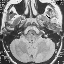 Osteosarcoma of jaw bones represents a distinct group of lesions from. Osteosarcoma Of The Mandibular Condyle Case Report Journal Of Oral And Maxillofacial Surgery
