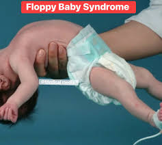 Image result for Floppy Infant