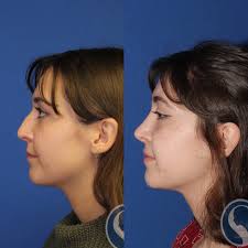 Ecstatic patient returned for follow up today and is in love with her 👃!  Combined aesthetic and functional rhinoplasty can improve breathing and  build confidence.... especially if they are built to last! #