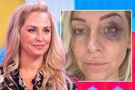 + add or change photo on imdbpro ». Boxer Who Left Josie Gibson With Black Eye In New Year S Fight Jailed Mirror Online