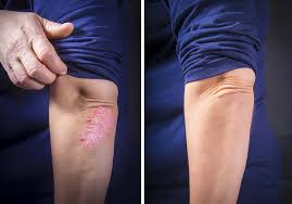 Quels produits sans ordonnance pour soigner un bouton de fièvre ? Acheter Dermacort Avis Prix Et Conseils Pour Soigner Le Psoriasis