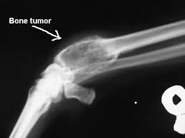 A type of bone cancer called osteosarcoma is the most common type of primary bone cancer in dogs, accounting for over 95% of all bone tumors. Osteosarcoma And Pain Management Preceding Home Pet Euthanasia Paws Into Grace