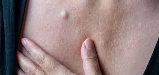 Image result for Cyst
