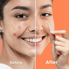 Amazon.com: LitBear Pimple Patches for Face, XL Hydrocolloid Face Mask for  Acne with Witch Hazel Oil, 10 Large Pimple Patches for Zit Breakouts