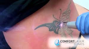 When it comes to tattoo removal methods, a lot has been done, technologically, to make improvement. Laser Tattoo Removal On Lower Back Tattoo By Comfortlaser Youtube