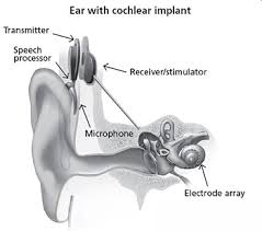 cochlear implants other implantable devices hearing loss