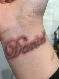 What Can I Do For Blisters After Laser Tattoo Removal Photos