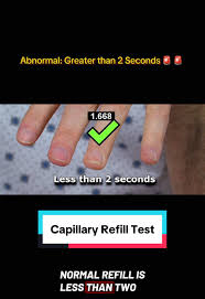 Image result for Capillary Refill