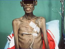 Image result for Cachexia in Cancer