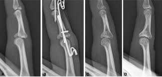 Image result for Lateral PIP Dislocation