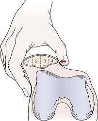 Image result for Patella Mobility Test