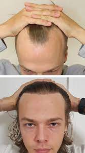 Top Quality Hair Transplant Hair Transplant Hair Implants Hair Transplant Results