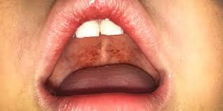 Image result for Strep throat infection roof of mouth