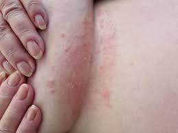 Image result for Candidiasis under breasts