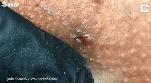 What would a small hard lump that moves with skin in groin area be? Grim Video Shows Pus Stream Out Of Woman S Bikini Line As Ingrown Hairs Are Pulled Out
