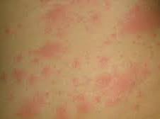 Sono stati visitati direttamente o indirettamente 148 pazienti positivi e, laddove possibile, è. Coronavirus Covid 19 E Doencas Alergicas Semana Mundial Da Alergia Asbai Mg