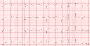 The Normal Ecg The Student Physiologist