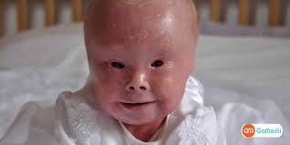 Image result for Ichthyosis