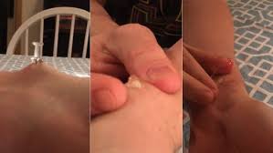 Make sure there isn't a underlying reason why this doesn't heal; Video Shows Man Popping A Large Ganglion Cyst On His Arm With A Pin Daily Mail Online
