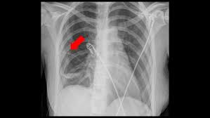 Atelectasis can make breathing difficult, particularly if you already have lung disease. Spontaneous Pneumothorax Children S Hospital Of Philadelphia