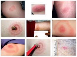 Een em ontstaat meestal binnen 1 tot 2 weken na een tekenbeet en is vaak het eerste symptoom van de ziekte van lyme. Niet Alleen Door Een Tekenbeet Claritas Protocol