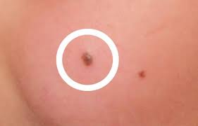 However, it is wise to have angiomas examined by a dermatologist, explains mohs surgeon, anthony rossi: How To Remove Red Moles Step To Health