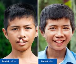 Operation Smile