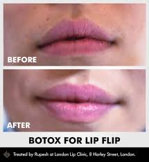 Lip treatments injections augmentation sherman oaks la. Before And After Images Of Botox Procedures London Lip Clinic