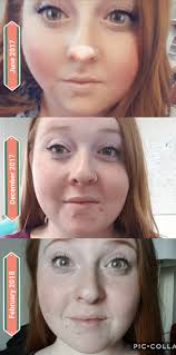 1month plus differences after fed SASI..