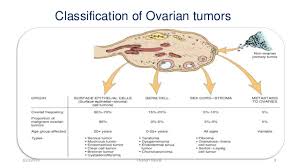 ovarian cancer