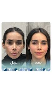 قبل و دو هفته بعد از درمان فول فیس, درمانهای پوستیشون رو هم پیگیری  میکنیم..., #فیلر #زیبایی #زیبایی_پوست #شیراز #دکتراحسان_صالح