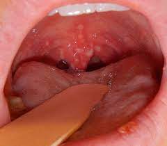 However, it's recommended to seek treatment for epstein pearls if they become painful. Herpangina Wikipedia