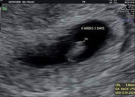 Changing lives one scan at a time. 6 Week Ultrasound Pictures Twins And What To Expect Bellybelly
