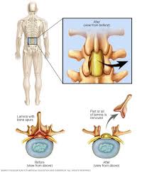 Removal Of Rear Portion Of A Vertebra In Lower Back Spinal Stenosis Lumbar Spinal Stenosis Spinal