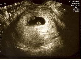 Twins 6 Week Ultrasound Ohh I Pray I Have Identical Twin Girls One Day Gravidez De Gemeos Ultrassom Gemeos