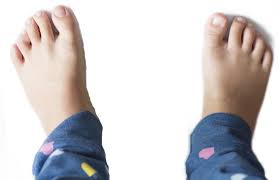 Image result for Out-toeing